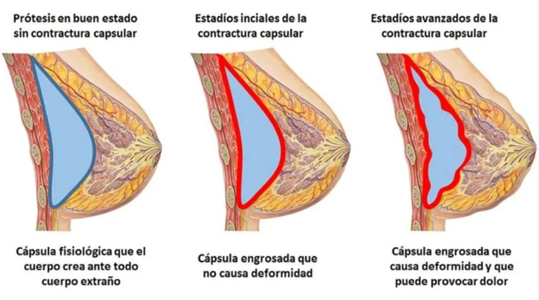 Cambio de Implantes Madrid